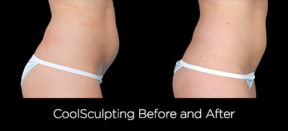 coolsculpting_3_1_1351703421.jpg