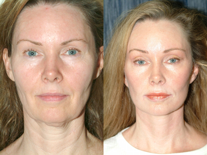 Stem Cell Face Life Before and After Photo