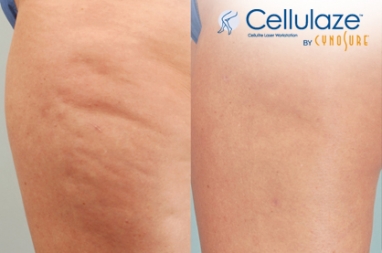 Breakthrough treatment for cellulite produces long-lasting results
