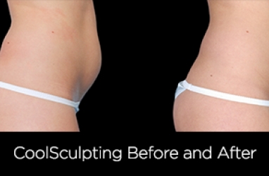 CoolSculpting: A Cool Way To Get In Shape