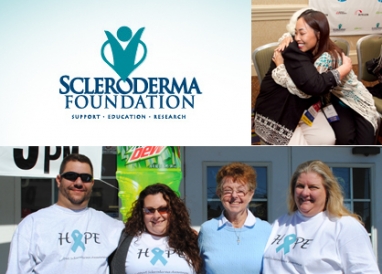 Scleroderma: A vicious disease